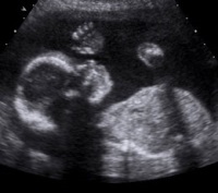 Ultrasound for Diagnostic Imaging – A primer